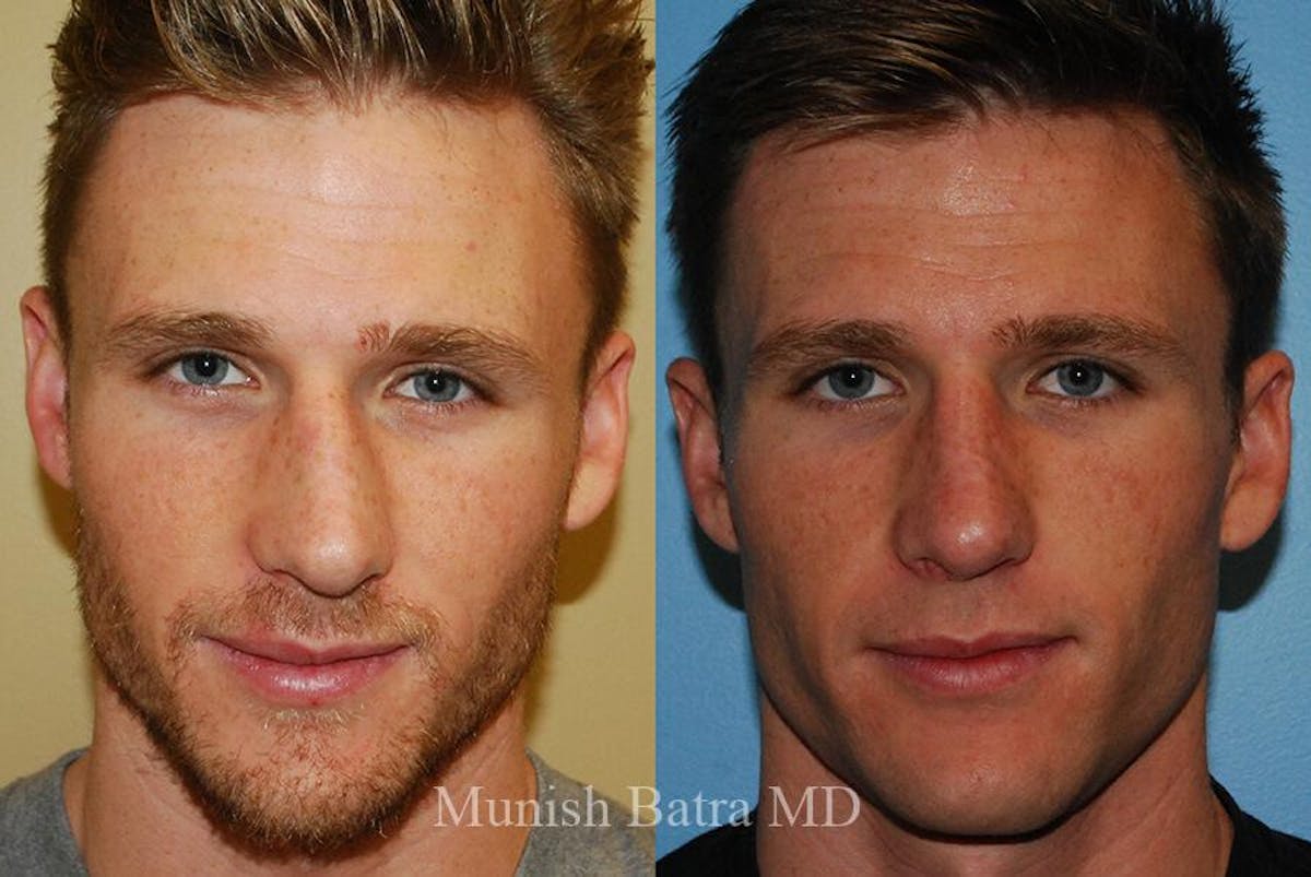 Male Rhinoplasty Before & After Gallery - Patient 156815 - Image 2