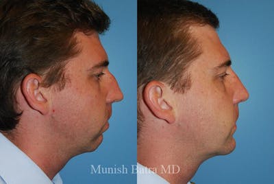 Male Rhinoplasty Before & After Gallery - Patient 335783 - Image 1