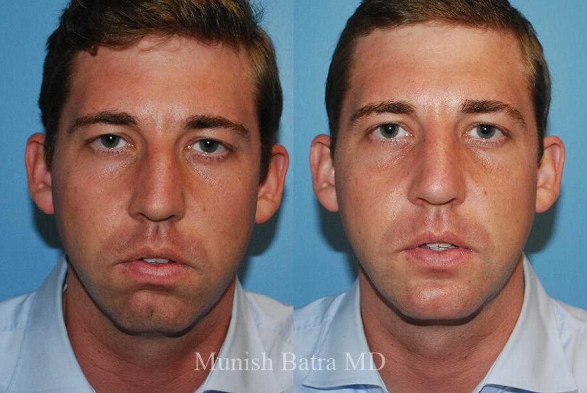 Male Rhinoplasty Before & After Gallery - Patient 335783 - Image 2