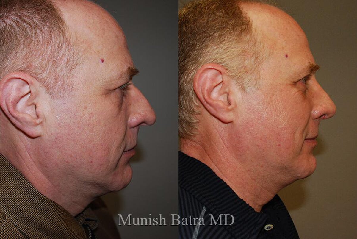 Male Rhinoplasty Before & After Gallery - Patient 234682 - Image 1