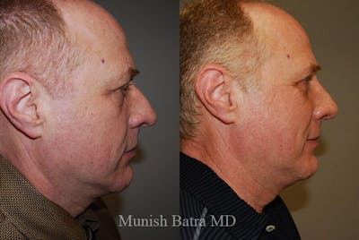 Male Rhinoplasty Before & After Gallery - Patient 234682 - Image 1