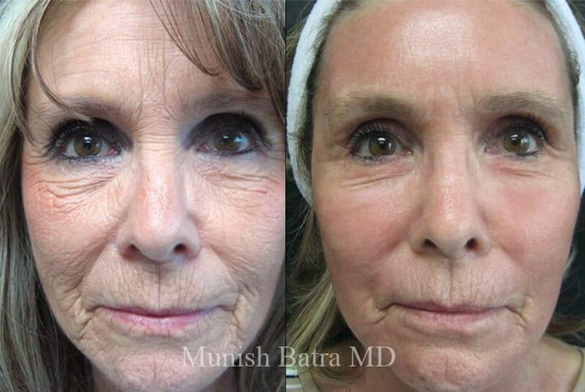 Fraxel Laser Before & After Gallery - Patient 219208 - Image 1