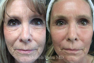 Fraxel Laser Before & After Gallery - Patient 219208 - Image 1
