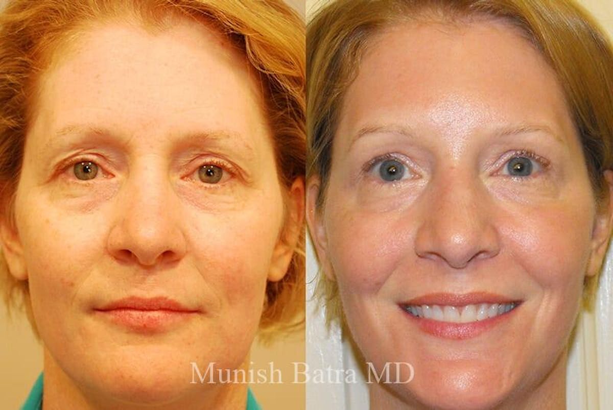 Fraxel Laser Before & After Gallery - Patient 354888 - Image 1