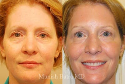 Fraxel Laser Before & After Gallery - Patient 354888 - Image 1