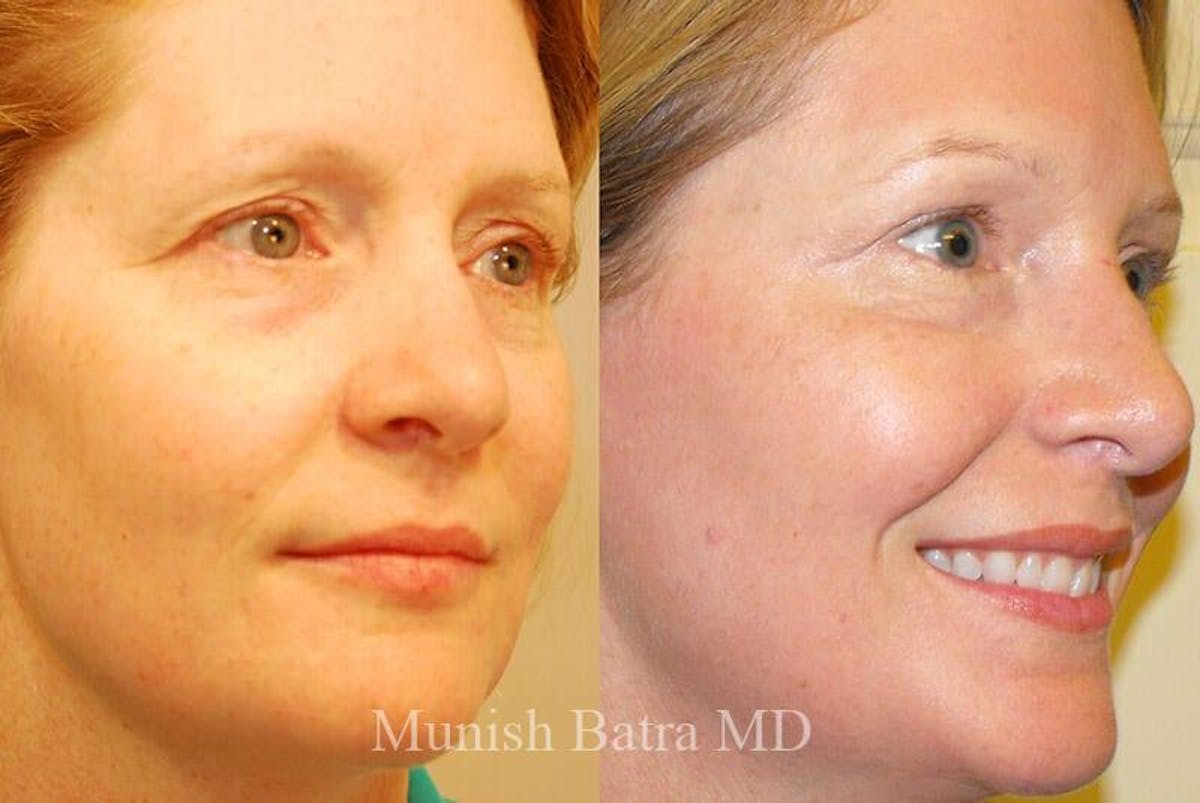 Fraxel Laser Before & After Gallery - Patient 354888 - Image 2