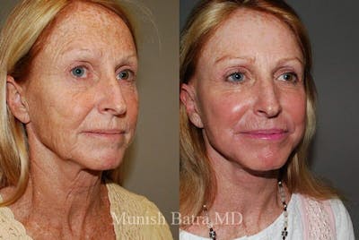 Fraxel Laser Before & After Gallery - Patient 427988 - Image 1