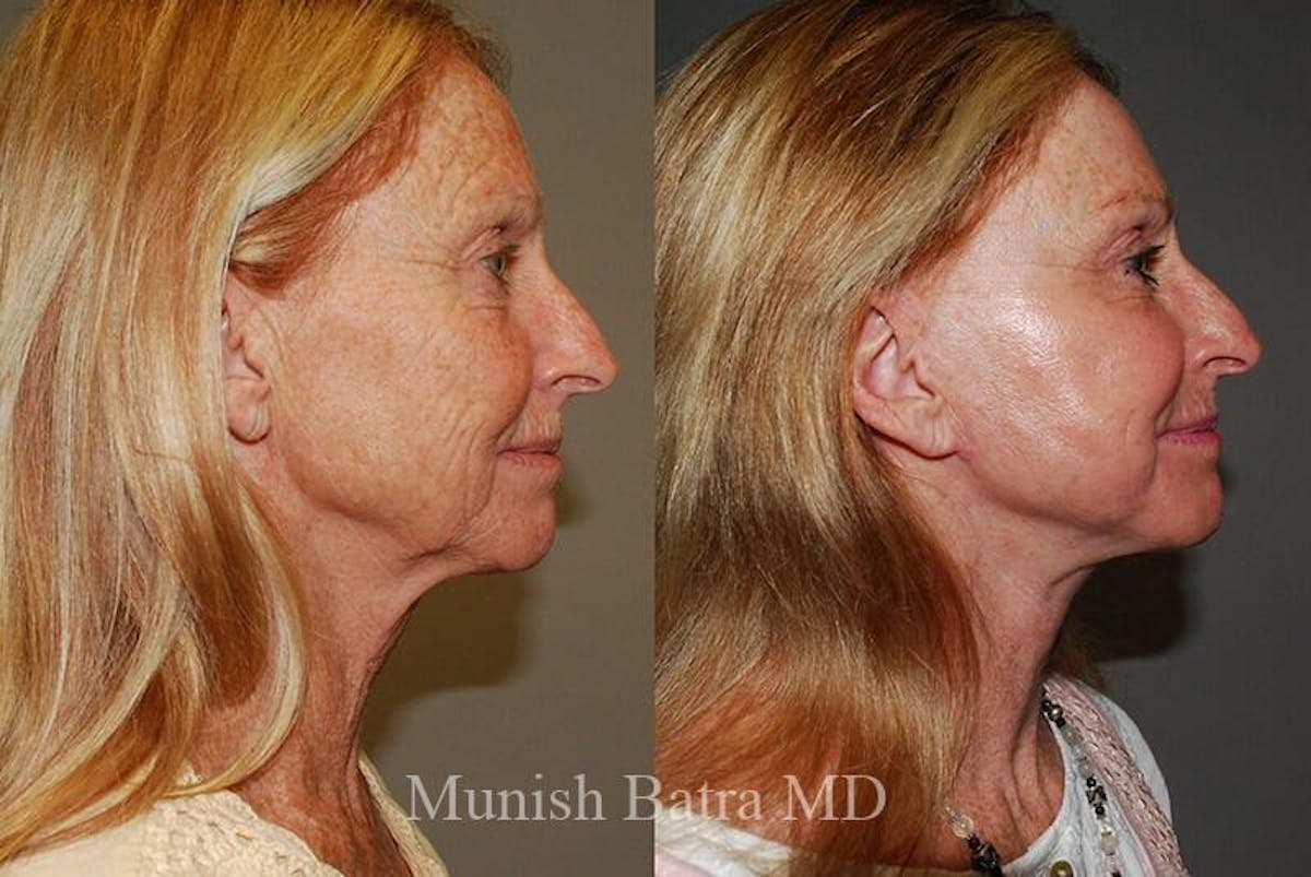 Fraxel Laser Before & After Gallery - Patient 427988 - Image 2