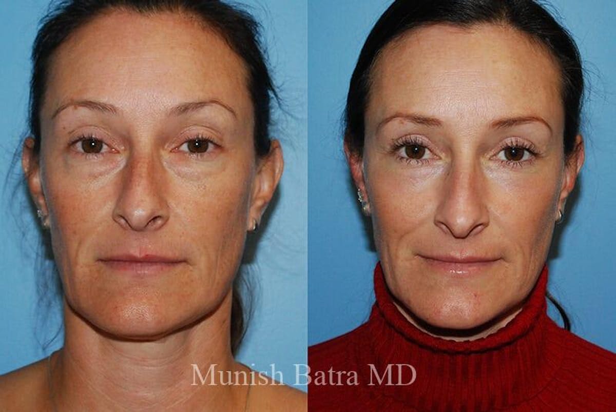 Fraxel Laser Before & After Gallery - Patient 752405 - Image 1