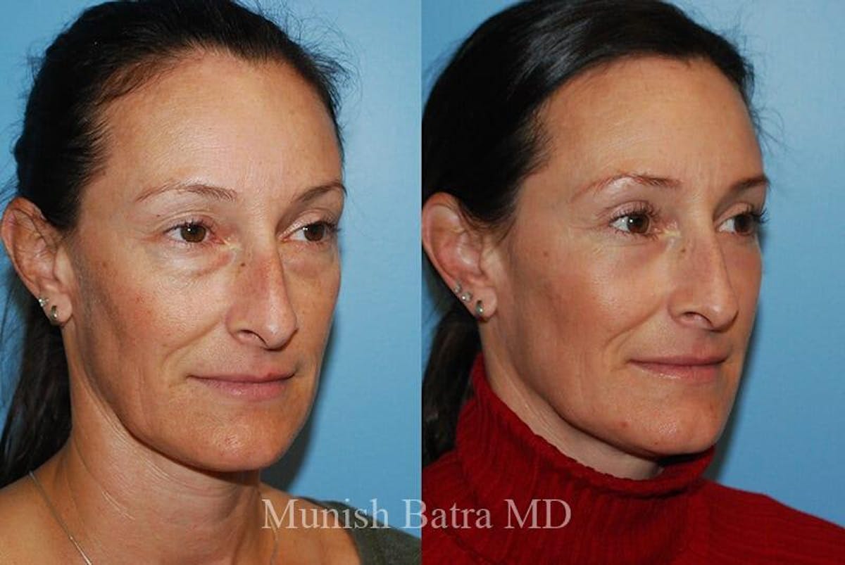 Fraxel Laser Before & After Gallery - Patient 752405 - Image 2