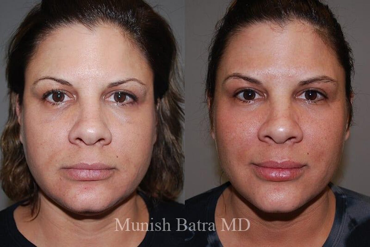 Fraxel Laser Before & After Gallery - Patient 384672 - Image 1