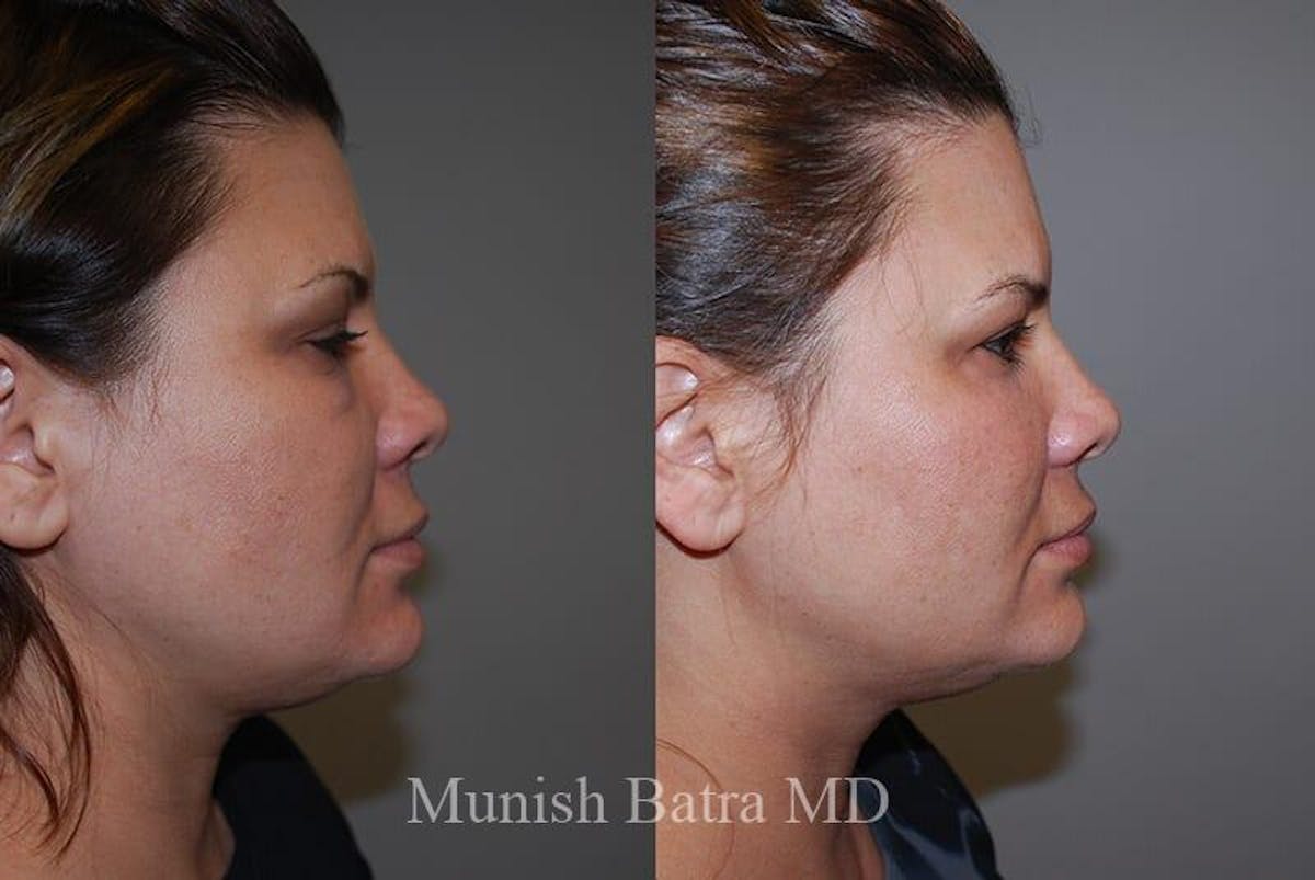 Fraxel Laser Before & After Gallery - Patient 384672 - Image 2