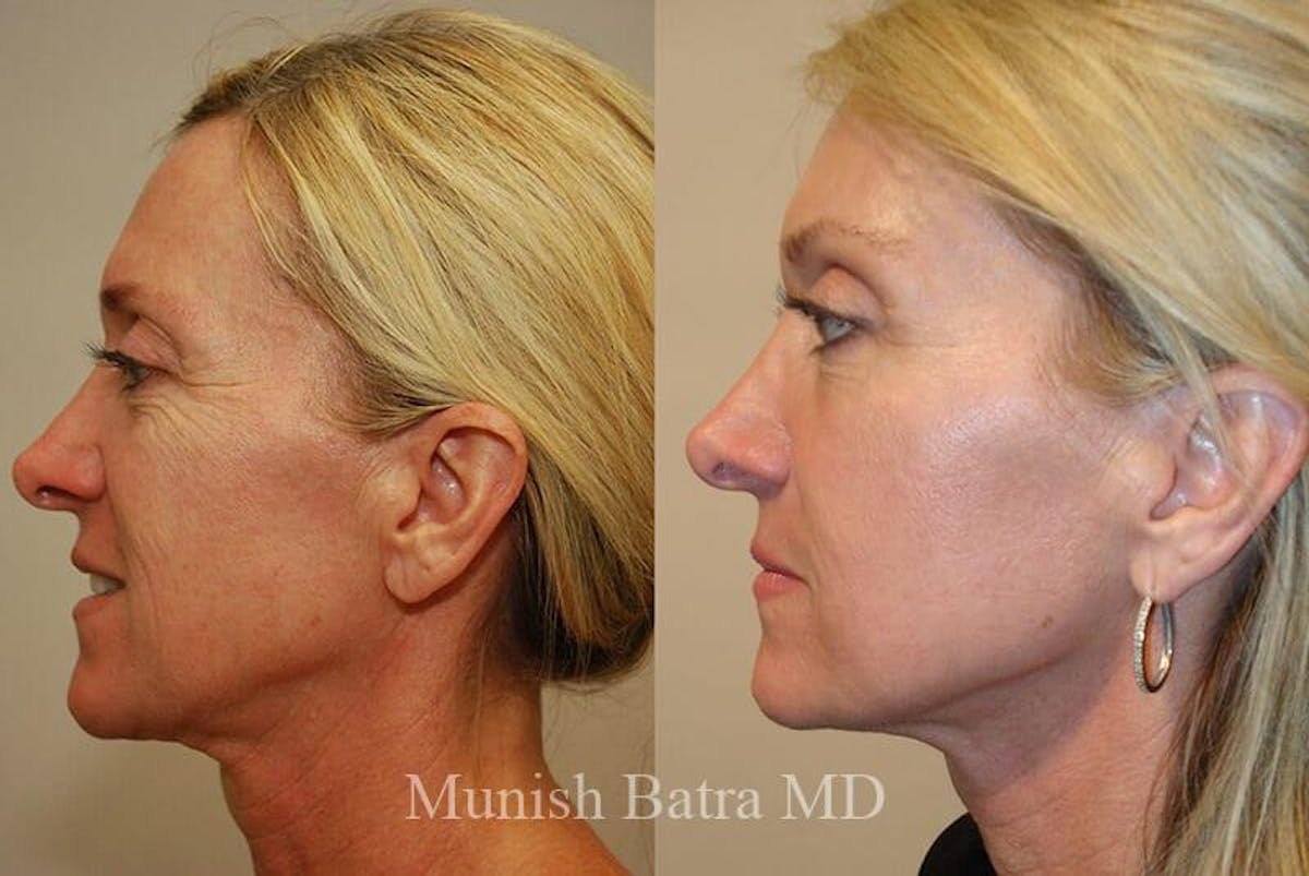 Fraxel Laser Before & After Gallery - Patient 420931 - Image 2