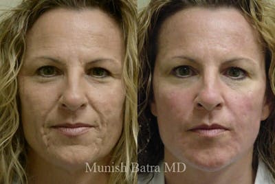Fraxel Laser Before & After Gallery - Patient 322527 - Image 1