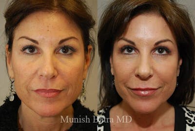 Fraxel Laser Before & After Gallery - Patient 145352 - Image 1