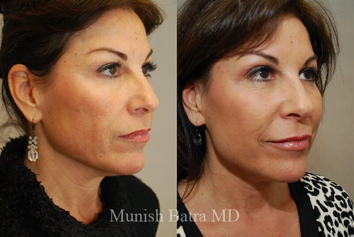 Fraxel Laser Before & After Gallery - Patient 145352 - Image 2