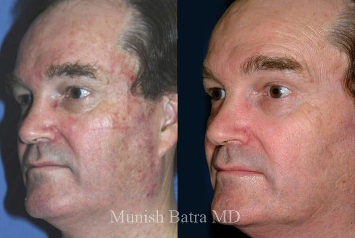 Fraxel Laser Before & After Gallery - Patient 218767 - Image 1