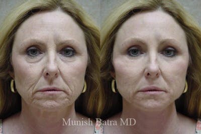 Fraxel Laser Before & After Gallery - Patient 153387 - Image 1