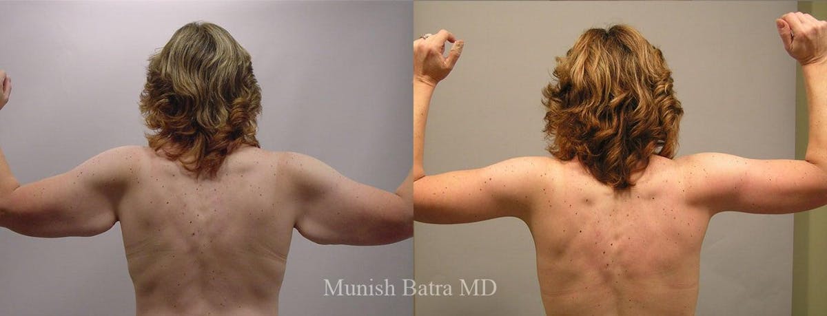 Arm Lift Before & After Gallery - Patient 268478 - Image 1