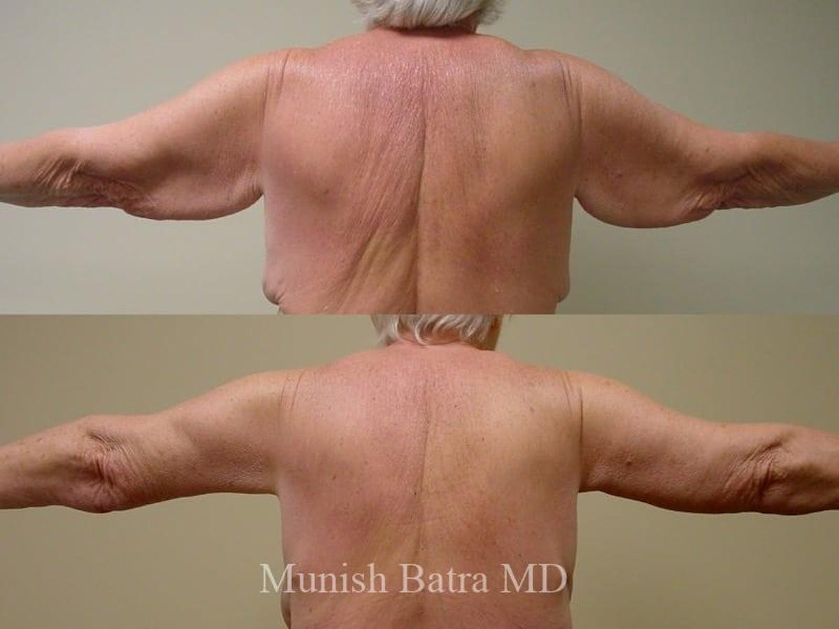 Arm Lift Before & After Gallery - Patient 247733 - Image 1