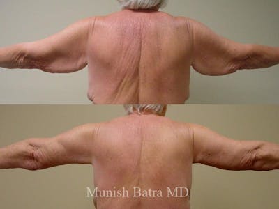 Arm Lift Before & After Gallery - Patient 247733 - Image 1