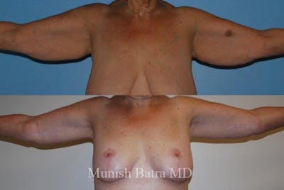 Arm Lift Before & After Gallery - Patient 150984 - Image 1