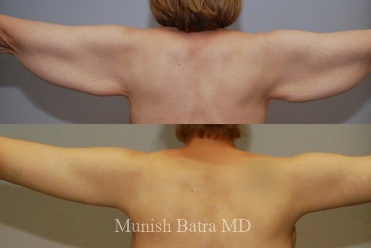 Arm Lift Before & After Gallery - Patient 734819 - Image 1