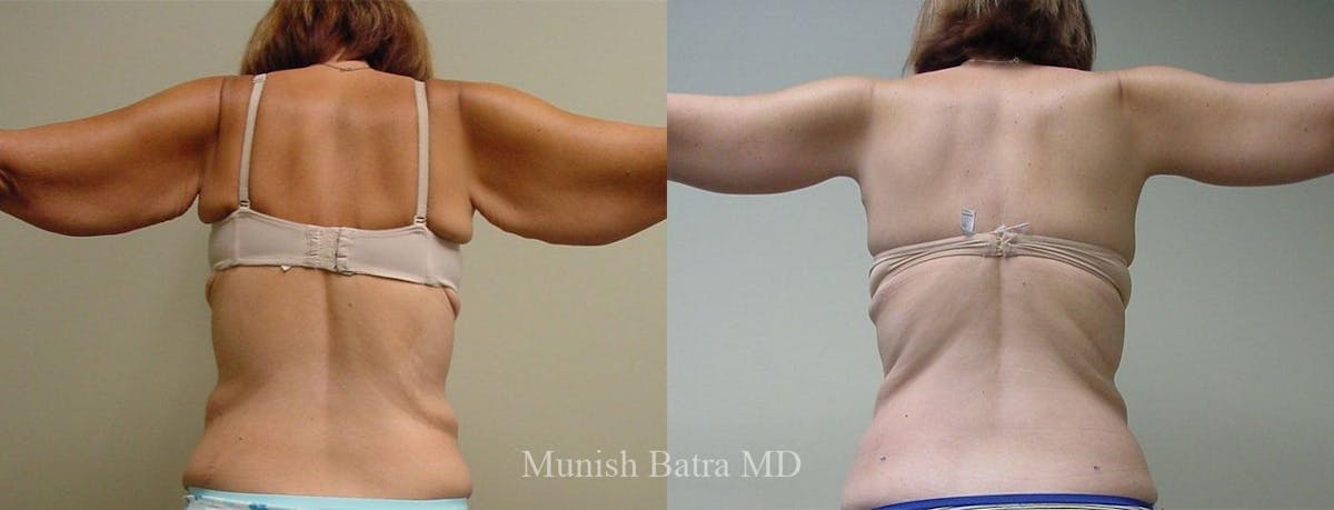 Arm Lift Before & After Gallery - Patient 326409 - Image 1