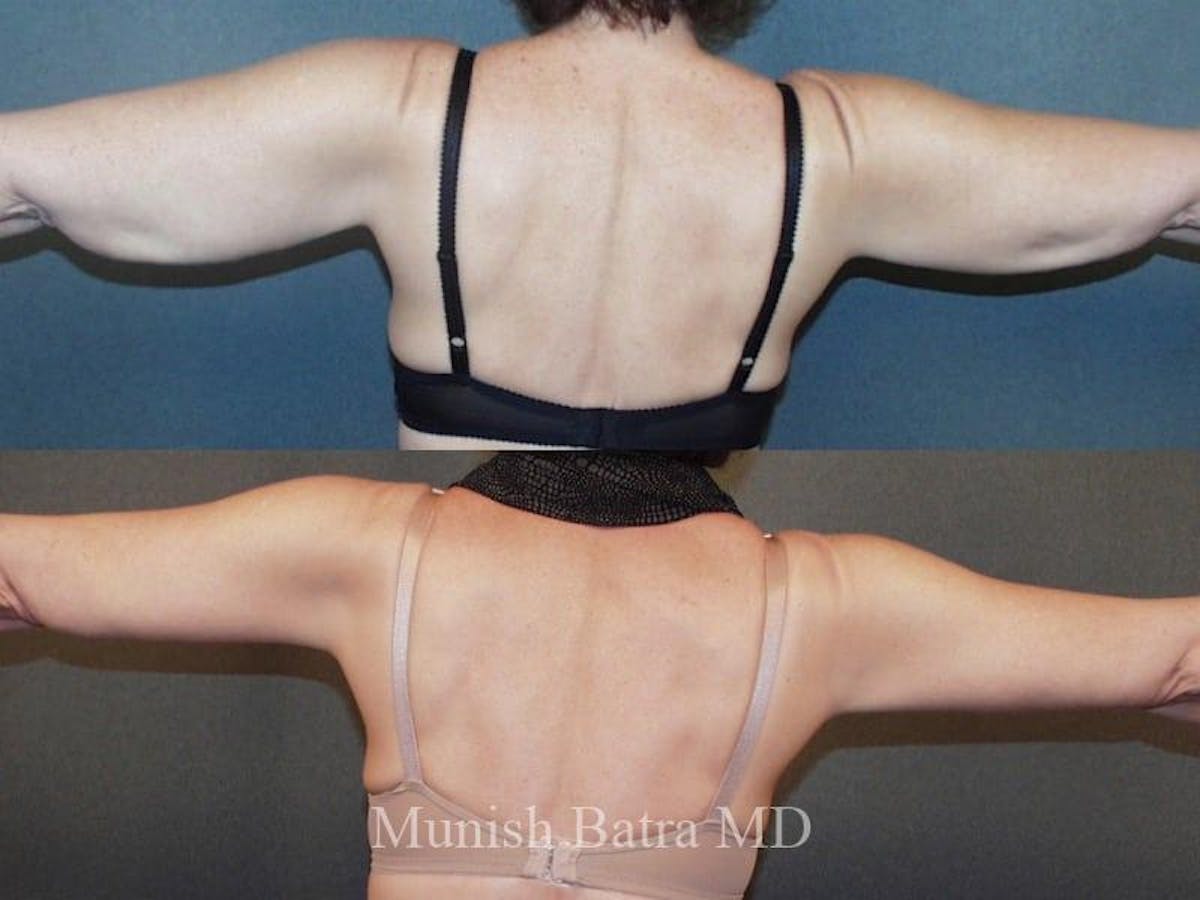 Arm Lift Before & After Gallery - Patient 287169 - Image 1