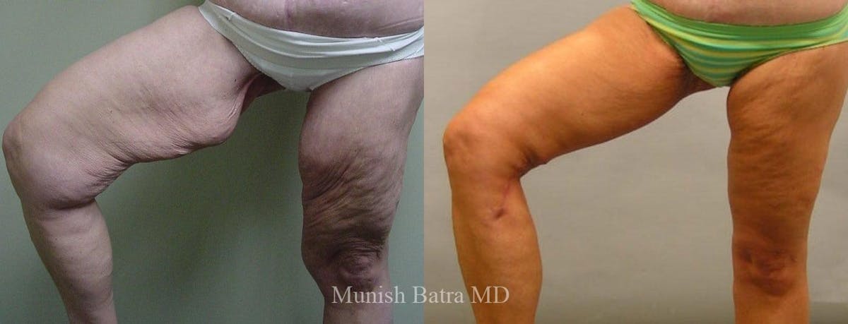 Thigh Lift Before & After Gallery - Patient 372848 - Image 1