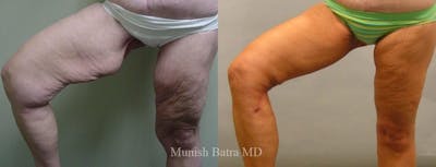 Thigh Lift Before & After Gallery - Patient 372848 - Image 1