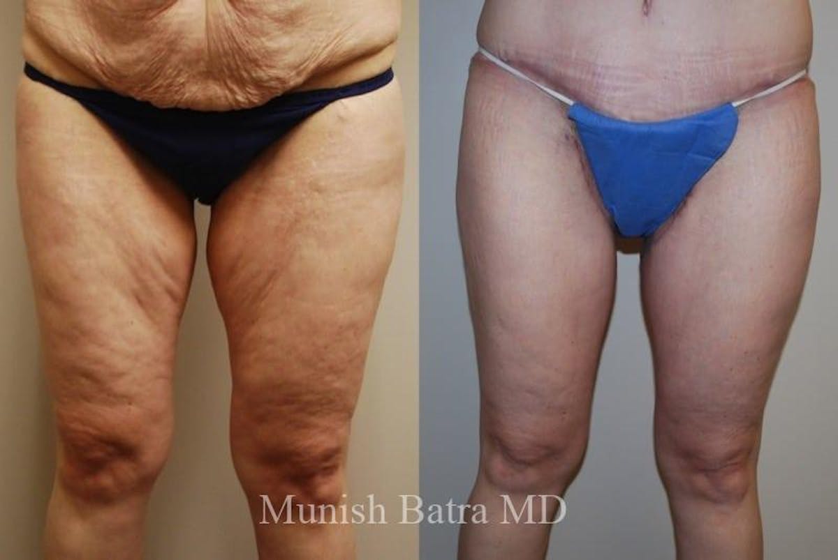 Thigh Lift Before & After Gallery - Patient 335804 - Image 1