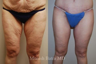 Thigh Lift Before & After Gallery - Patient 335804 - Image 1