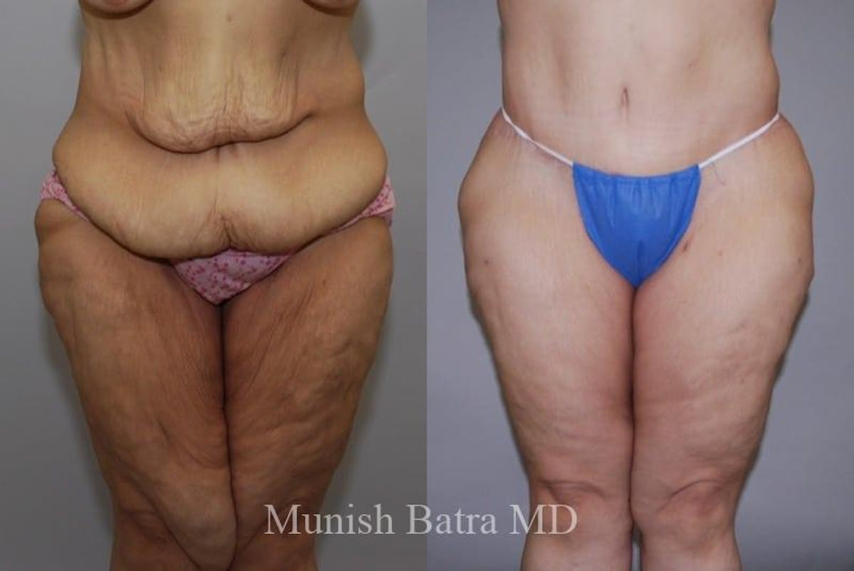 Thigh Lift Before & After Gallery - Patient 315328 - Image 1