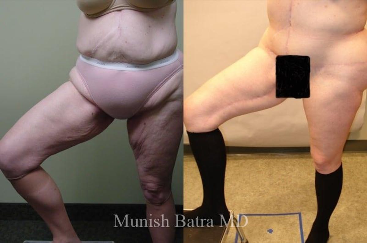 Thigh Lift Before & After Gallery - Patient 237750 - Image 1