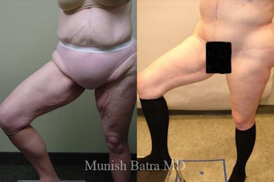 Thigh Lift Before & After Gallery - Patient 237750 - Image 1