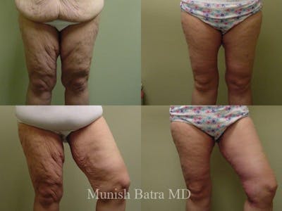 Thigh Lift Before & After Gallery - Patient 188393 - Image 1