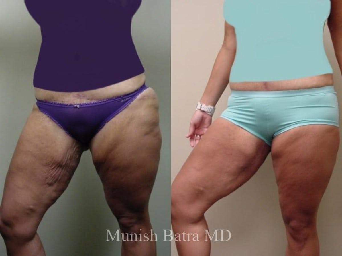 Thigh Lift Before & After Gallery - Patient 355647 - Image 1