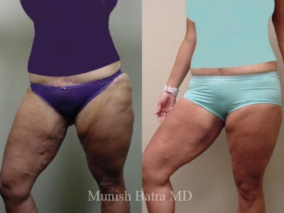 Thigh Lift Before & After Gallery - Patient 355647 - Image 1