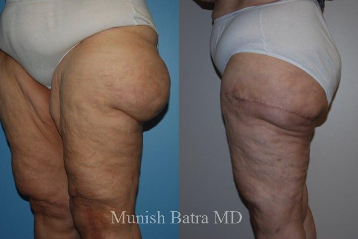Thigh Lift Before & After Gallery - Patient 201995 - Image 1