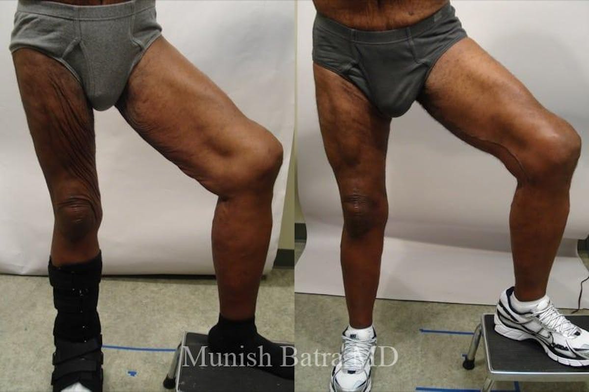 Thigh Lift Before & After Gallery - Patient 254730 - Image 1