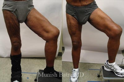 Thigh Lift Before & After Gallery - Patient 254730 - Image 1