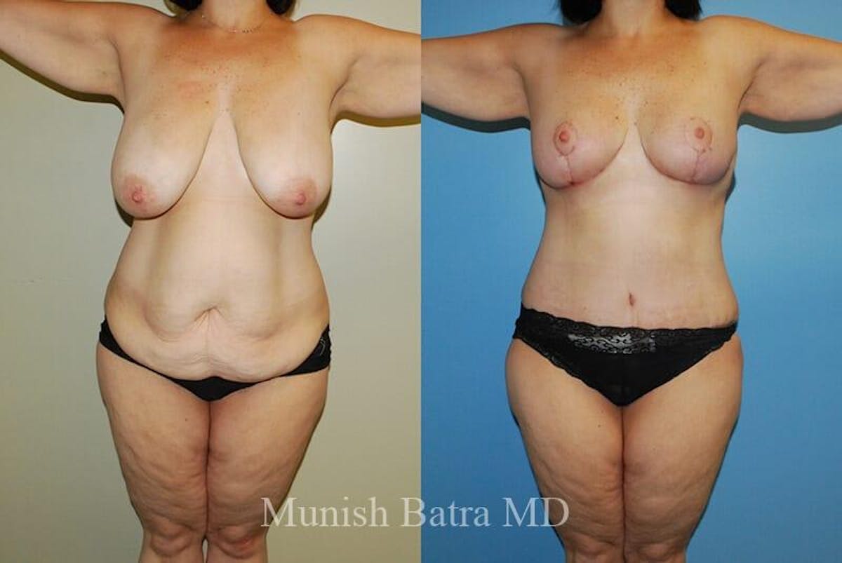 GBRX Abdominoplasty Reconstruction Before & After Gallery - Patient 199297 - Image 1