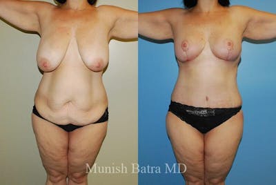 GBRX Abdominoplasty Reconstruction Before & After Gallery - Patient 199297 - Image 1