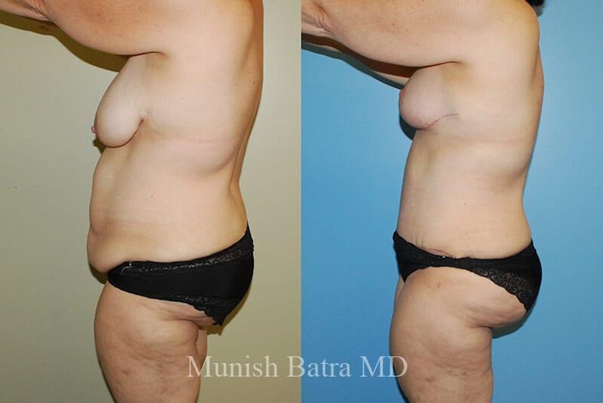 GBRX Abdominoplasty Reconstruction Before & After Gallery - Patient 199297 - Image 2