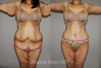 GBRX Abdominoplasty Reconstruction Before & After Gallery - Patient 123874 - Image 1