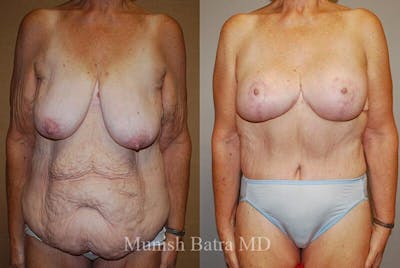 GBRX Abdominoplasty Reconstruction Before & After Gallery - Patient 312167 - Image 1
