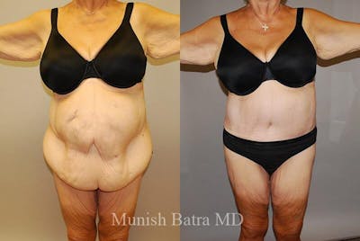 GBRX Abdominoplasty Reconstruction Before & After Gallery - Patient 627494 - Image 1