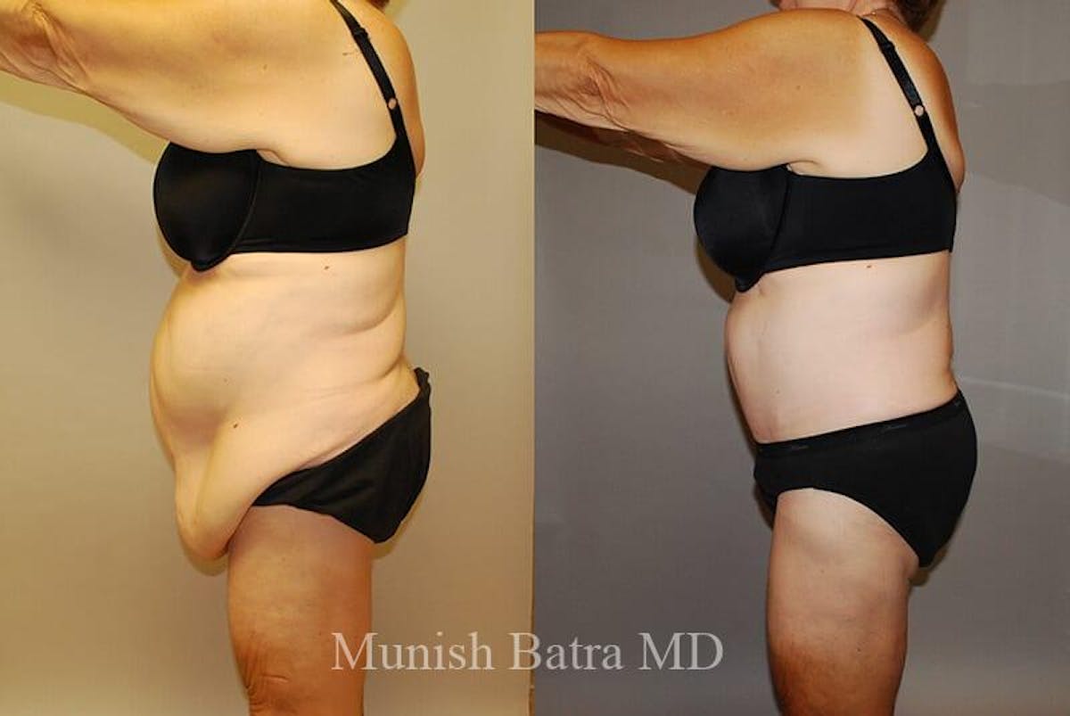 GBRX Abdominoplasty Reconstruction Before & After Gallery - Patient 627494 - Image 2