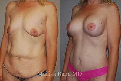 GBRX Abdominoplasty Reconstruction Before & After Gallery - Patient 255026 - Image 1